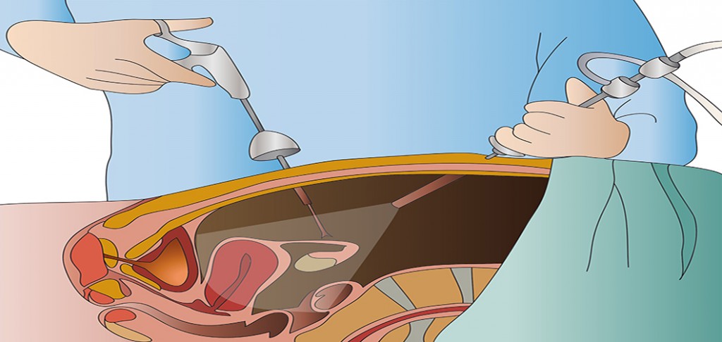 Most_Common_Laparoscopic_Procedures-1-1024x486.jpg