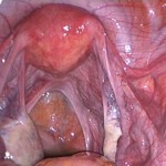 ivf5